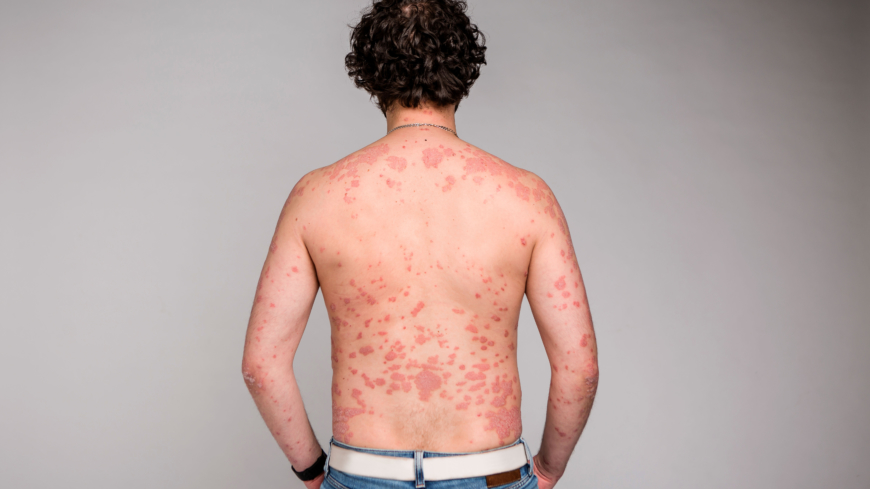 Socialstyrelsen bedömer att det finns en stor underbehandling av psoriasis i landet men även att de regionala skillnaderna är stora. Foto: Shutterstock